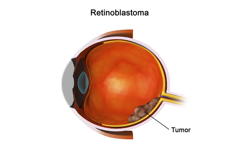 Meistens bleibt ein kleines Retinoblastom erstmal unentdeckt, bis sich deutlichere Symptome äußern. Das erschwert eine frühzeitige Diagnose und Behandlung.