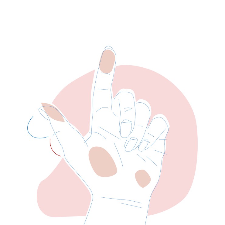 Dieses Bild zeigt eine Hand, bei der die untere Hälfte des Daumens kleiner ist.
