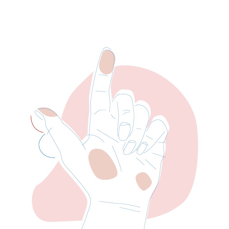 Dieses Bild zeigt eine Hand, bei der der untere Teil des Daumens größer ist als der obere.