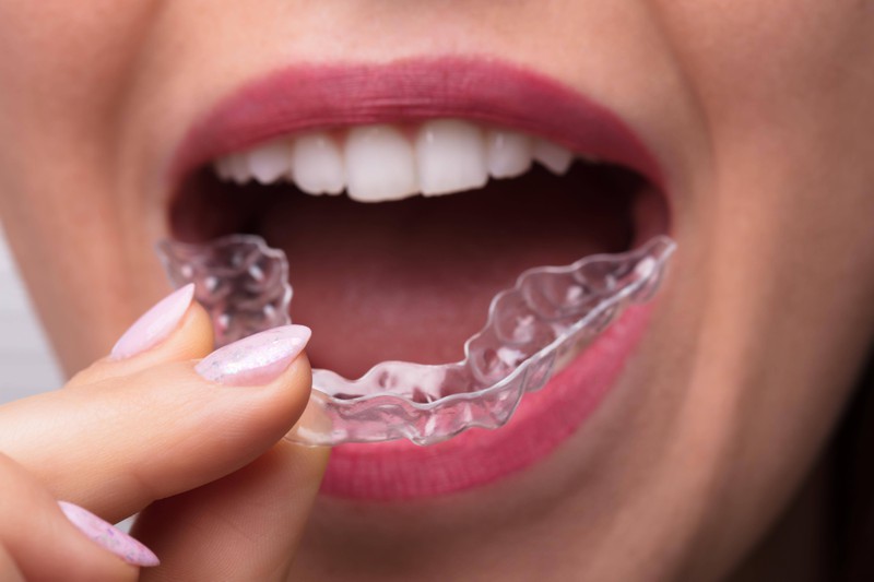 Eine Zahnschiene hilft, den Kiefer vor Zähneknirschen zu schützen