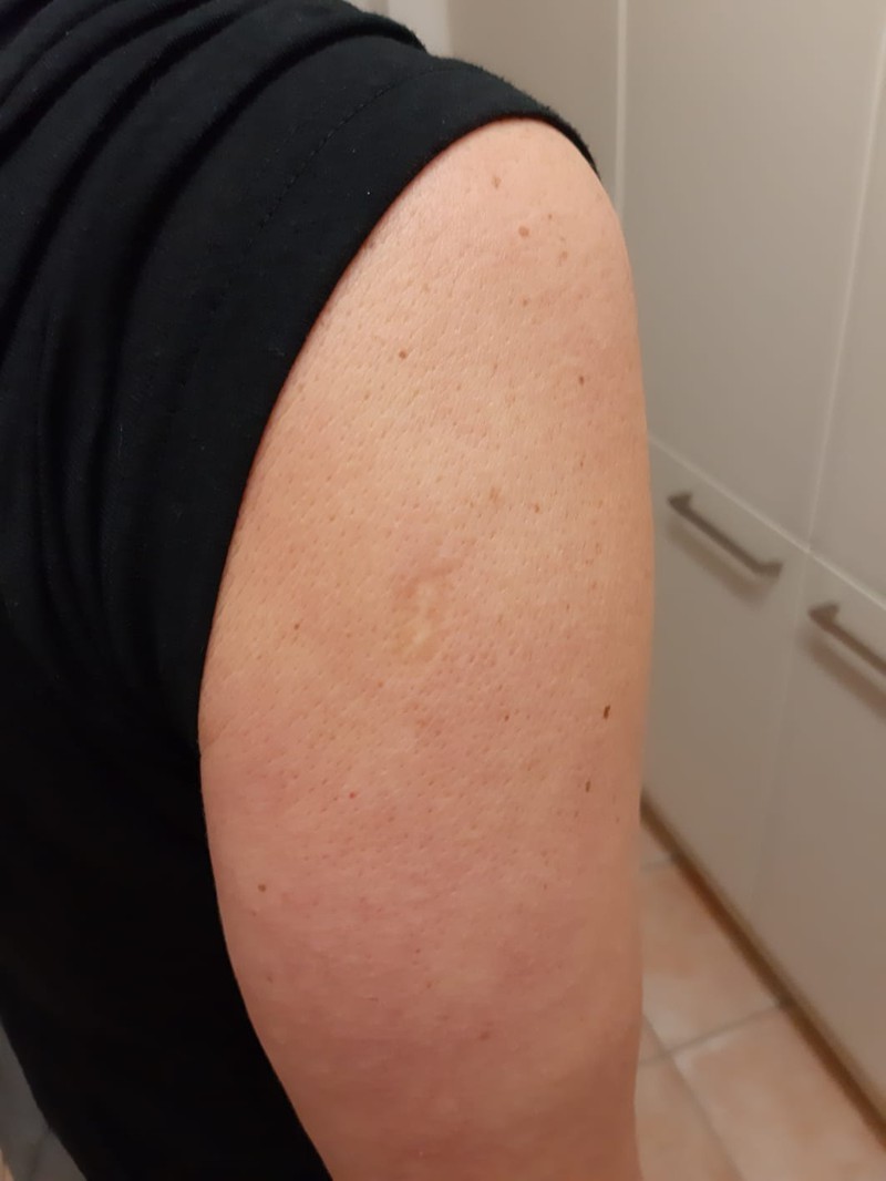 Zu sehen ist eine Pockenimpfung-Narbe auf einem Oberarm.
