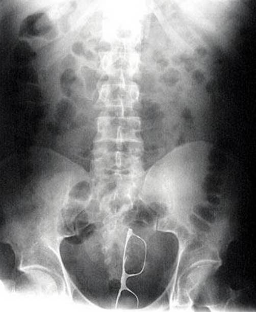 Röntgen-Bild von einer Brille im falschen Körperteil
