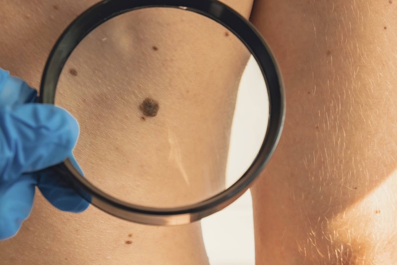 Mit Lupe und Auflichtmikroskop werden Muttermale beim Hautkrebs-Screening untersucht.