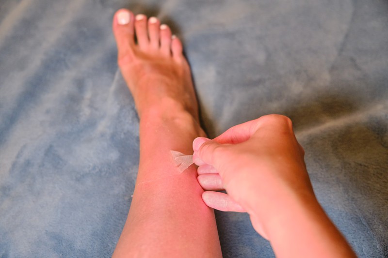 Man sollte einen Sonnenbrand nicht abpellen, das kann den Heilungsprozess verzögern.