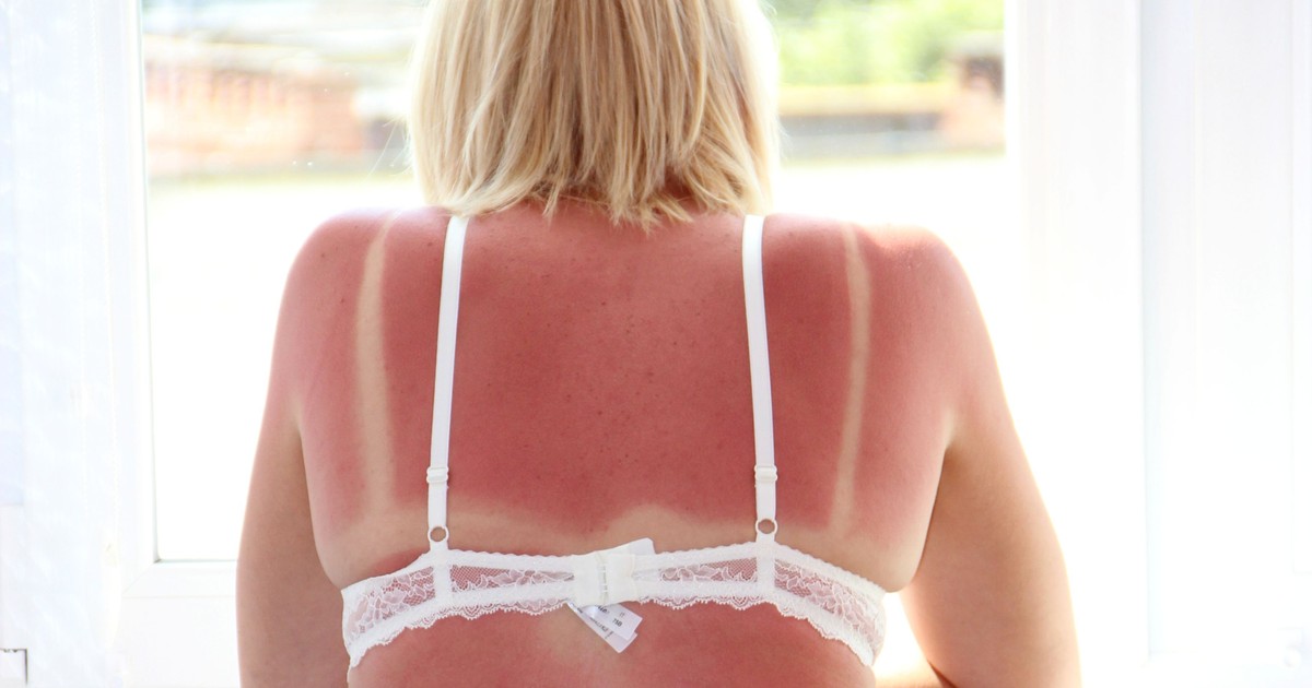 Was hilft gegen einen Sonnenbrand? Die besten Tipps und Hausmittel