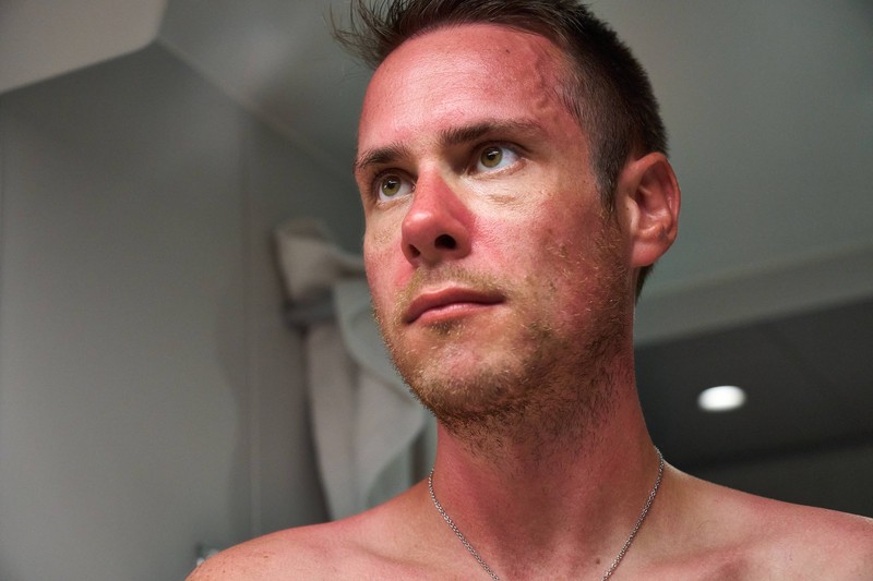 Sonnenbrand entsteht durch zu viel UV-Strahlung – mit diesen Tipps lässt er sich lindern.
