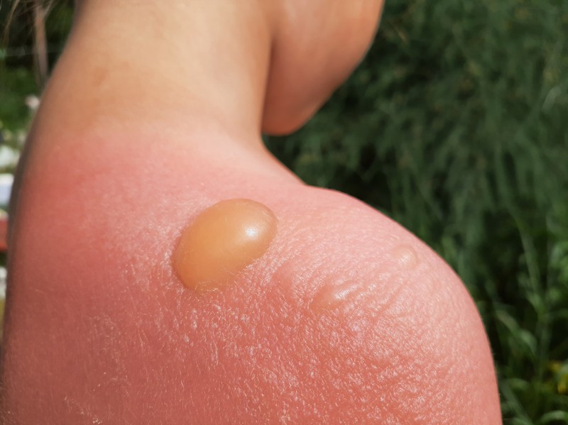 Sonnenbrand mit Blasenbildung erfordert besondere Vorsicht – auf keinen Fall aufstechen.