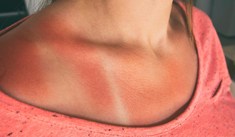 Was hilft gegen einen Sonnenbrand? Die besten Tipps