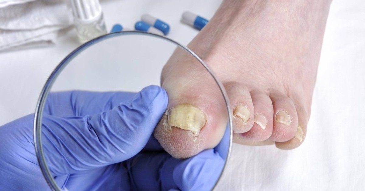 Nagelpilz: Ursachen, Symptome und Behandlung