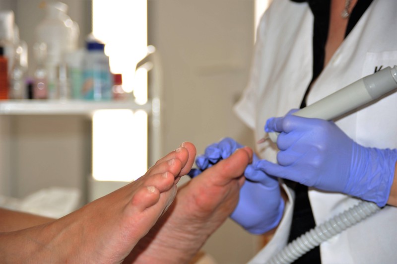 Auch wenn er harmlos ist, sollte Nagelpilz frühzeitig behandelt werden, da er selten von selbst verschwindet.