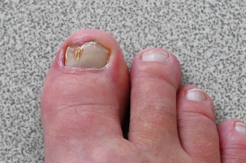 Eine frühzeitige Behandlung bei Nagelpilz ist das A und O.