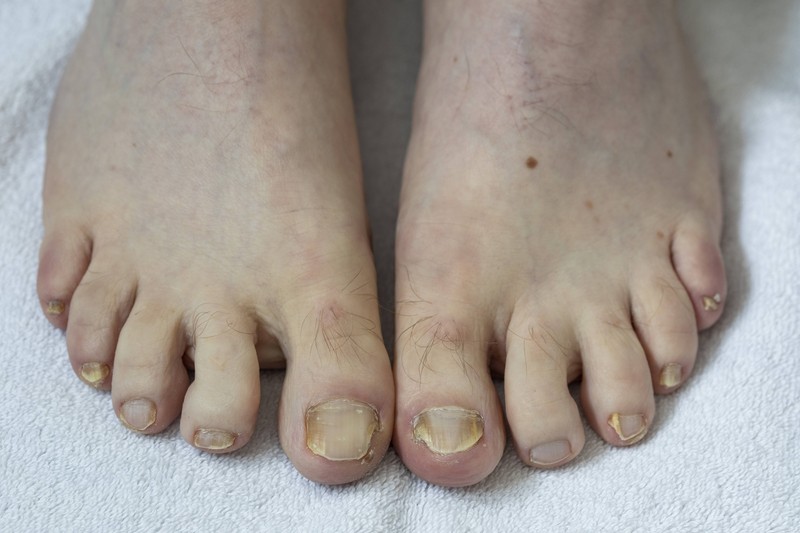 Nagelpilz entwickelt sich meist langsam und unbemerkt.