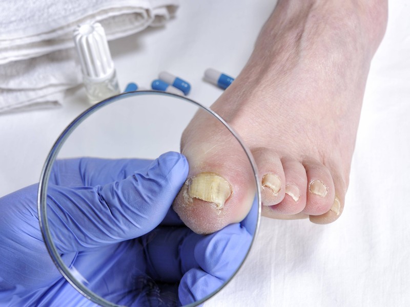 Nagelpilz ist weit verbreitet und betrifft vor allem die Fußnägel. Besonders Männer und ältere Menschen sind häufiger betroffen.