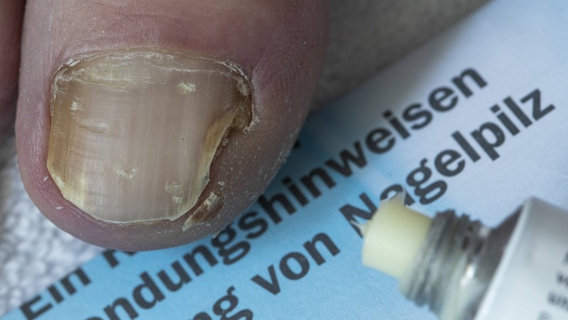 Nagelpilz kann jeden treffen, tritt aber mit zunehmendem Alter deutlich häufiger auf.